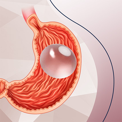 CDG | Balão Intragástrico